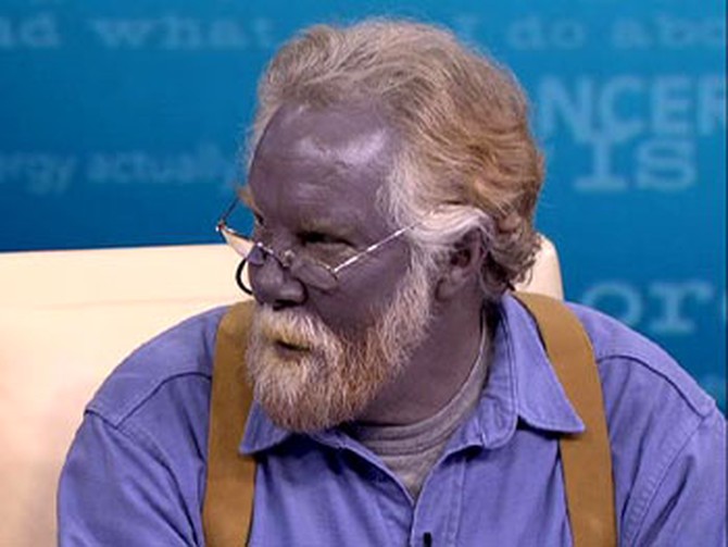 Blue man Paul Karason is still blue after he self-medicates with